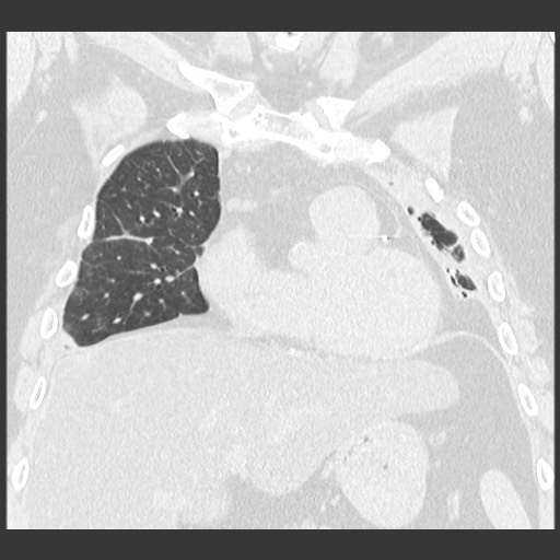 File:Chronic lung allograft dysfunction - restrictive form (Radiopaedia 60595-68316 Coronal lung window 41).jpg