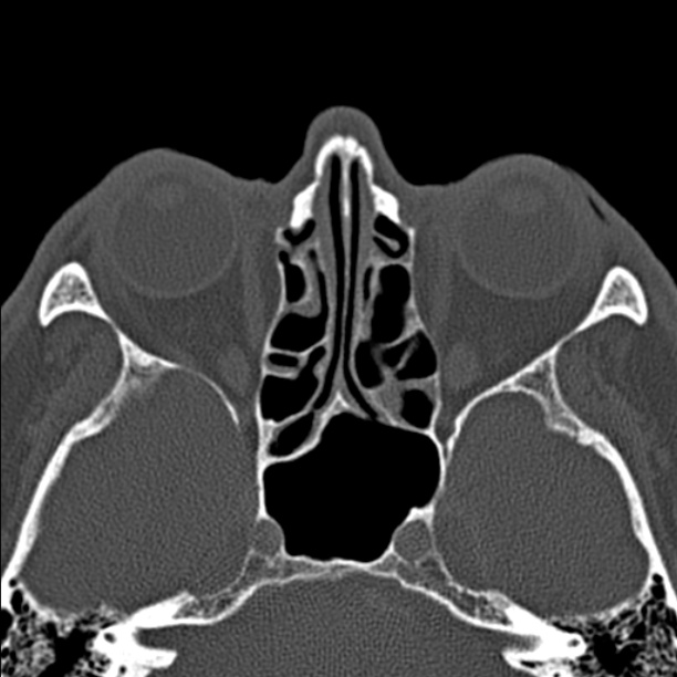 Chronic maxillary sinusitis (Radiopaedia 27879-28116 Axial bone window 32).jpg