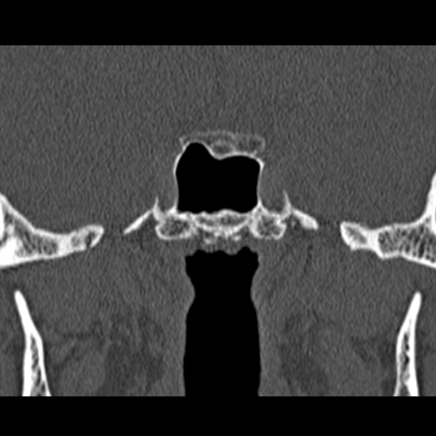 Chronic maxillary sinusitis (Radiopaedia 27879-28116 Coronal bone window 53).jpg