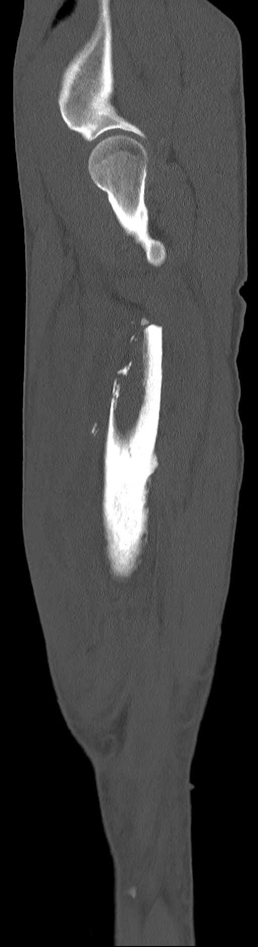 Chronic osteomyelitis (with sequestrum) (Radiopaedia 74813-85822 C 89).jpg