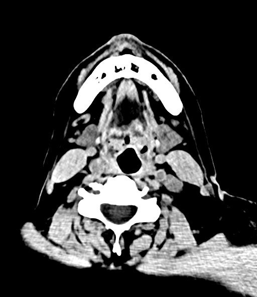 File:Chronic osteomyelitis - calvarial (severe) (Radiopaedia 69668-79616 Axial non-contrast 1).jpg