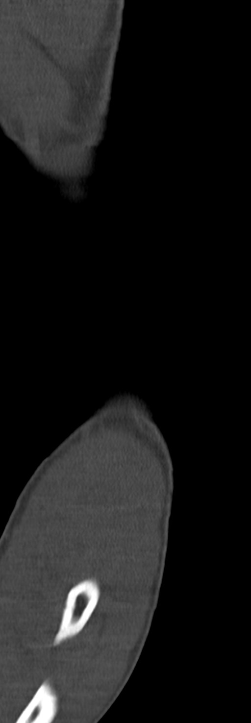 Chronic osteomyelitis of the distal humerus (Radiopaedia 78351-90971 Sagittal bone window 27).jpg