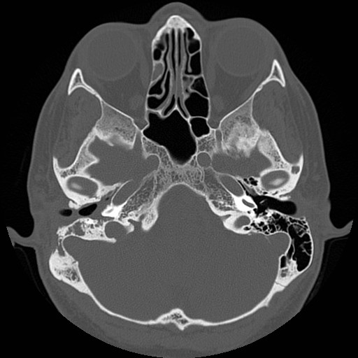 File:Chronic otomastoiditis (Radiopaedia 27138-27309 Axial bone window 27).jpg