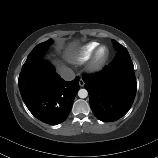 Chronic pulmonary embolus (Radiopaedia 39129-41341 Axial C+ CTPA 78).png