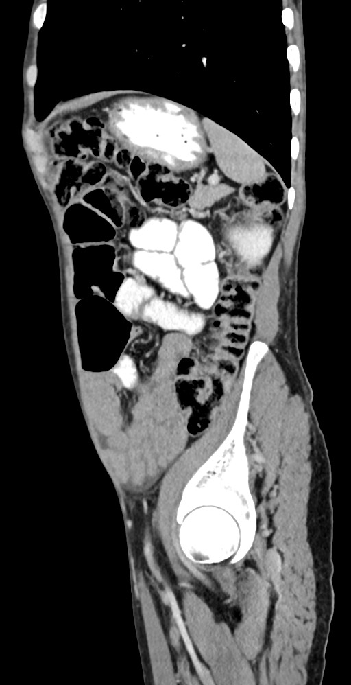 Chronic small bowel volvulus (Radiopaedia 75224-86322 C 39).jpg