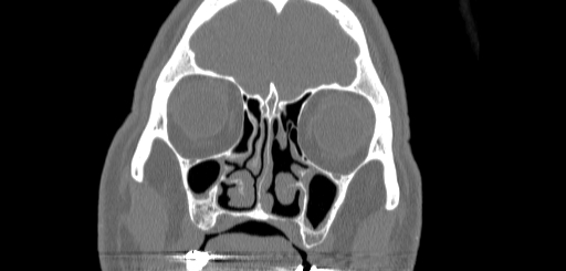 Chronic sphenoidal sinusitis (Radiopaedia 62030-70122 Coronal bone window 48).jpg