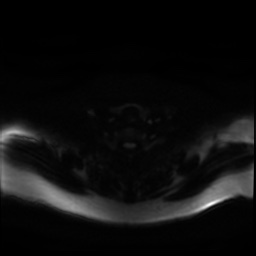 Chronic submandibular sialadenitis (Radiopaedia 61852-69885 Axial DWI 25).jpg