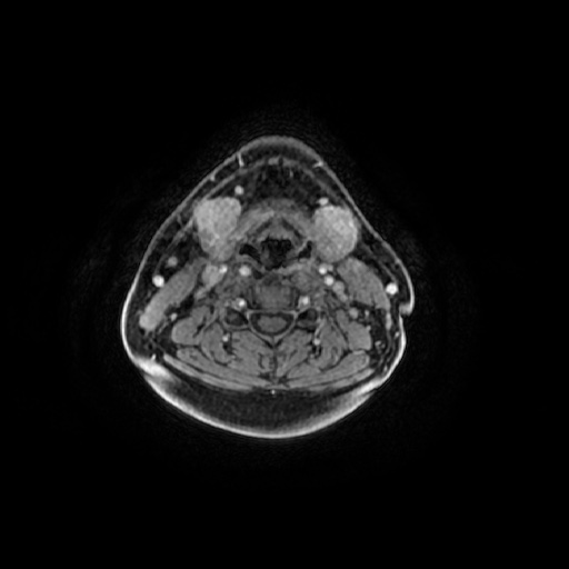 Chronic submandibular sialadenitis (Radiopaedia 61852-69885 Axial T1 C+ fat sat 39).jpg