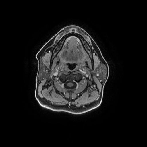 Chronic submandibular sialadenitis (Radiopaedia 61852-69885 Axial T1 C+ fat sat 70).jpg