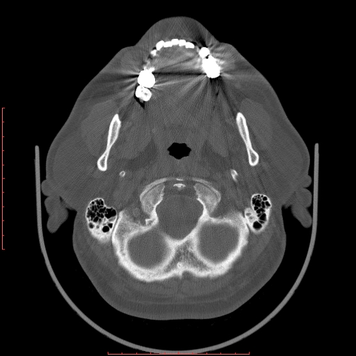 Chronic submandibular sialolithiasis (Radiopaedia 69817-79814 Axial bone window 16).jpg