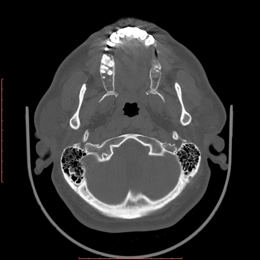 Chronic submandibular sialolithiasis (Radiopaedia 69817-79814 Axial bone window 5).jpg