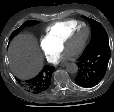 File:Chronic thromboembolic pulmonary disease (Radiopaedia 90694-108119 Axial C+ CTPA 68).jpg