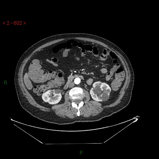 File:Circumaortic left renal vein and doubled left renal arteries (Radiopaedia 52268-58158 A 138).jpg