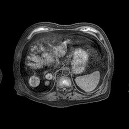 File:Cirrhosis and hepatocellular carcinoma in the setting of hemochromatosis (Radiopaedia 75394-86594 Axial T1 C+ fat sat 52).jpg