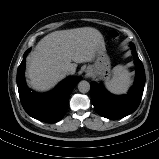 Classic complicated silicosis (Radiopaedia 49720-54961 Axial liver window 49).jpg