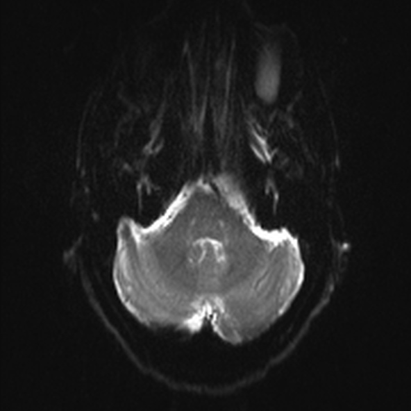 File:Clival meningioma (Radiopaedia 53278-59248 Axial DWI 5).jpg