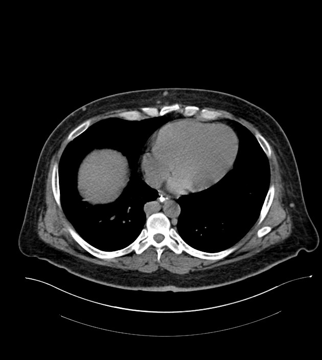 Closed-loop small bowel obstruction-internal hernia (Radiopaedia 78439-91096 Axial non-contrast 11).jpg