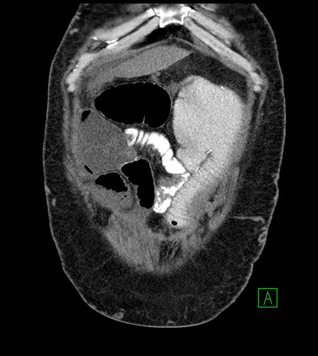 Closed-loop small bowel obstruction-internal hernia (Radiopaedia 78439-91096 Coronal non-contrast 23).jpg