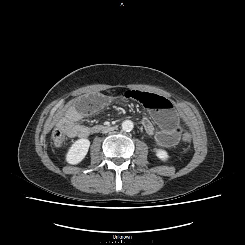 Closed loop bowel obstruction and ischemia (Radiopaedia 86959-103180 A 39).jpg