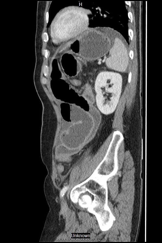 Closed loop bowel obstruction and ischemia (Radiopaedia 86959-103180 C 14).jpg