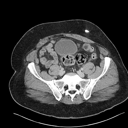 File:Closed loop obstruction - internal hernia into nephrectomy bed (Radiopaedia 59867-67320 A 107).jpg