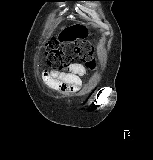 Closed loop obstruction - internal hernia into nephrectomy bed (Radiopaedia 59867-67320 B 5).jpg