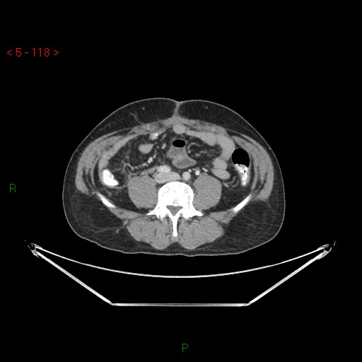 File:Closed loop obstruction and appendicular stump mucocele (Radiopaedia 54014-61158 A 49).jpg