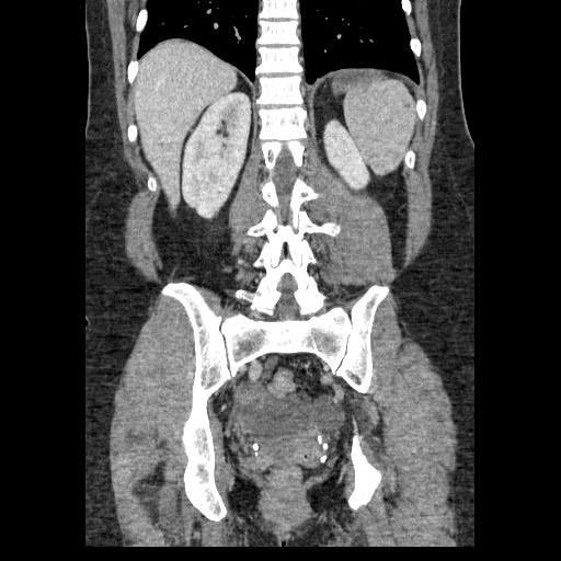 Closed loop small bowel obstruction (Radiopaedia 65403-74451 B 77).jpg