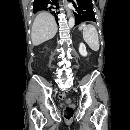 Closed loop small bowel obstruction - adhesive disease and hemorrhagic ischemia (Radiopaedia 86831-102990 B 91).jpg