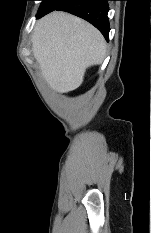 Closed loop small bowel obstruction - internal hernia (Radiopaedia 57806-64778 C 101).jpg