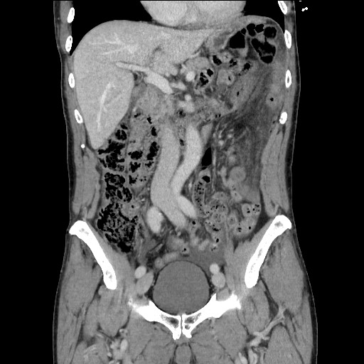 File:Closed loop small bowel obstruction - omental adhesion causing "internal hernia" (Radiopaedia 85129-100682 B 58).jpg