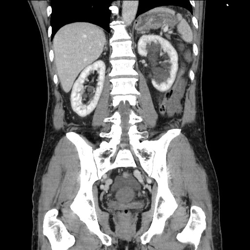 Closed loop small bowel obstruction - omental adhesion causing "internal hernia" (Radiopaedia 85129-100682 B 87).jpg