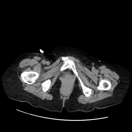Closed loop small bowel obstruction due to adhesive band, with intramural hemorrhage and ischemia (Radiopaedia 83831-99017 Axial non-contrast 164).jpg