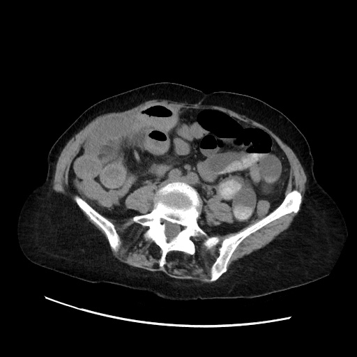 File:Closed loop small bowel obstruction due to adhesive band, with intramural hemorrhage and ischemia (Radiopaedia 83831-99017 Axial non-contrast 98).jpg
