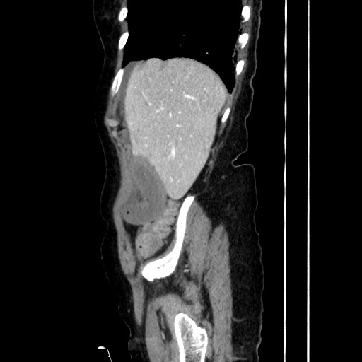 Closed loop small bowel obstruction due to adhesive band, with intramural hemorrhage and ischemia (Radiopaedia 83831-99017 D 53).jpg