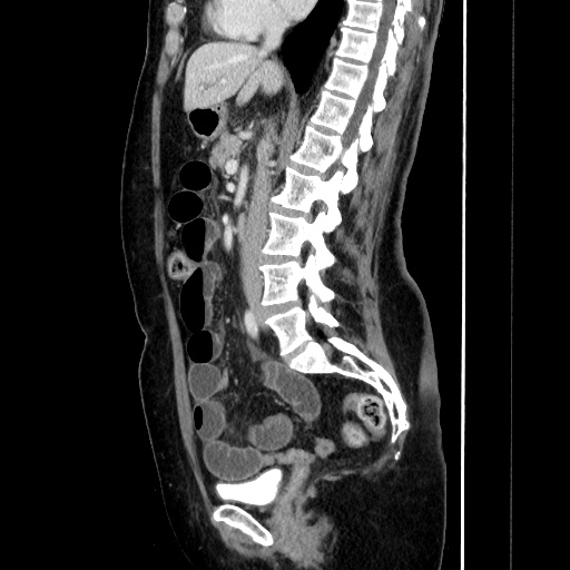 Closed loop small bowel obstruction due to adhesive bands - early and late images (Radiopaedia 83830-99015 C 87).jpg