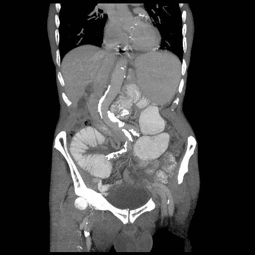 File:Closed loop small intestinal obstruction (Radiopaedia 16156-15835 Coronal non-contrast 5).png