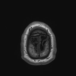 File:Cochlear incomplete partition type III associated with hypothalamic hamartoma (Radiopaedia 88756-105498 Axial T1 185).jpg