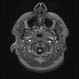 File:Cochlear incomplete partition type III associated with hypothalamic hamartoma (Radiopaedia 88756-105498 Axial T1 24).jpg