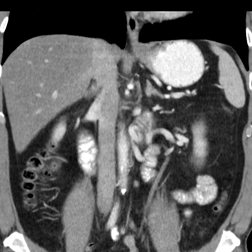 File:Collateral circulation following left renal vein thrombosis (Radiopaedia 17319-17013 renal cortical phase 15).jpg