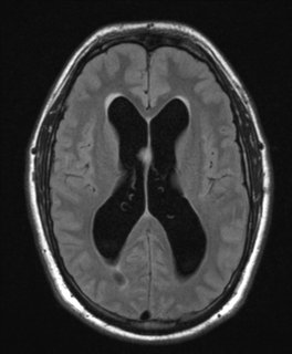 File:Colloid cyst (Radiopaedia 44510-48181 Axial FLAIR 16).png