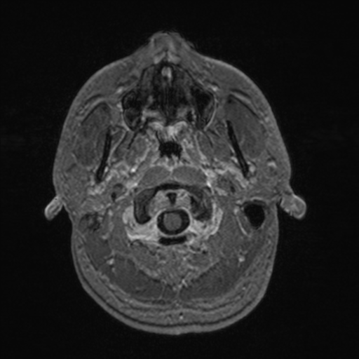 File:Colloid cyst (Radiopaedia 44510-48181 Axial T1 C+ 21).png