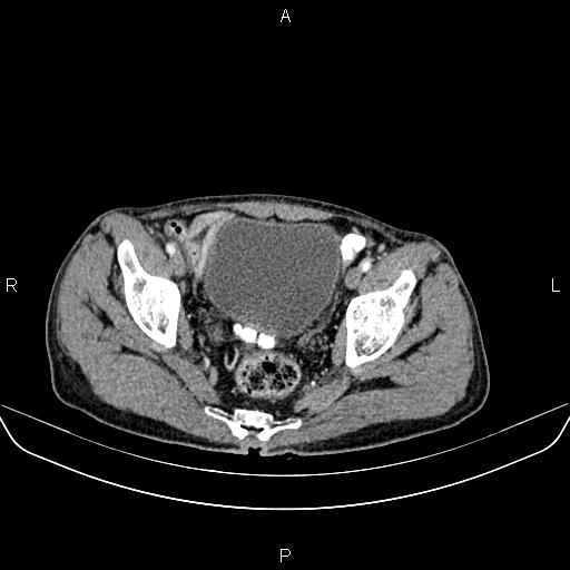Colon adenocarcinoma - hepatic flexure (Radiopaedia 85635-101395 A 85).jpg