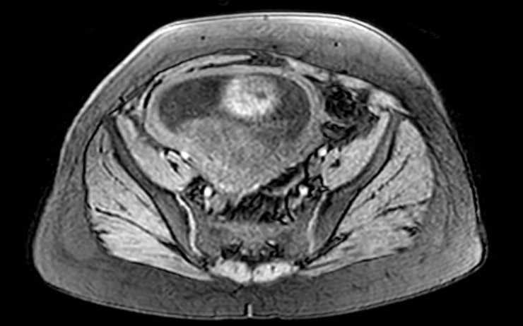 File:Colon adenocarcinoma with Krukenberg tumors, advanced pregnancy (Radiopaedia 67279-76645 A 23).jpg