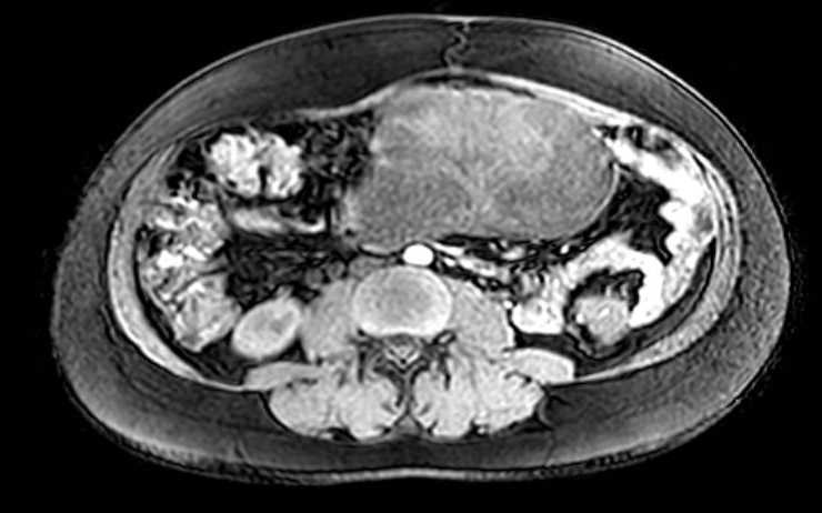 Colon adenocarcinoma with Krukenberg tumors, advanced pregnancy (Radiopaedia 67279-76645 A 42).jpg