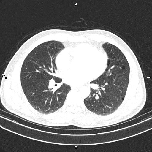 File:Colon cancer (Radiopaedia 85663-101443 Axial lung window 38).jpg