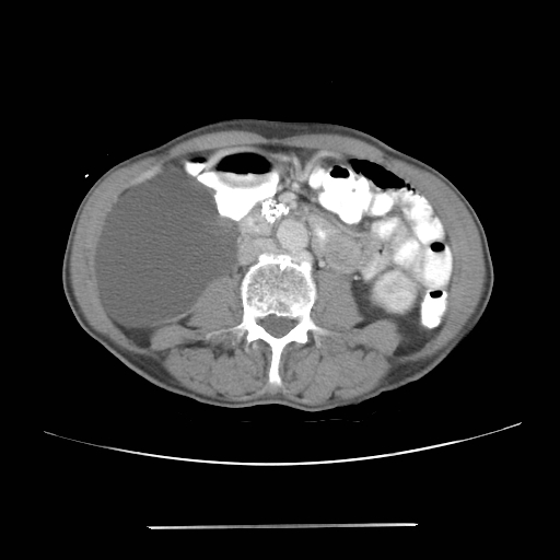 File:Colon cancer with calcified liver metastasis (Radiopaedia 74423-85307 A 37).jpg