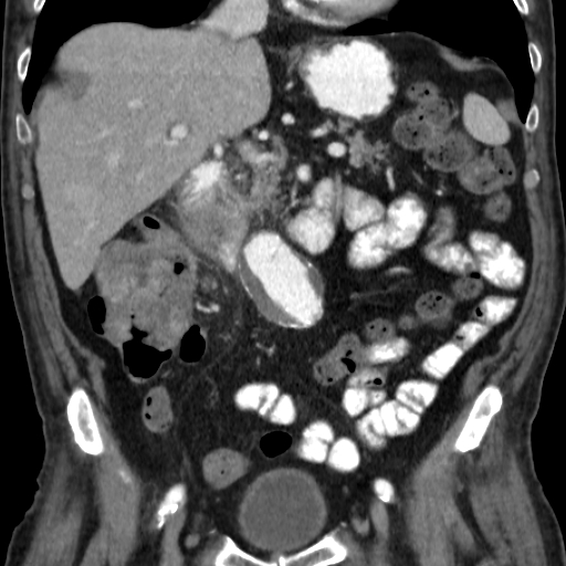 File:Colon cancer with duodenal invasion (Radiopaedia 16278-15958 B 28).jpg