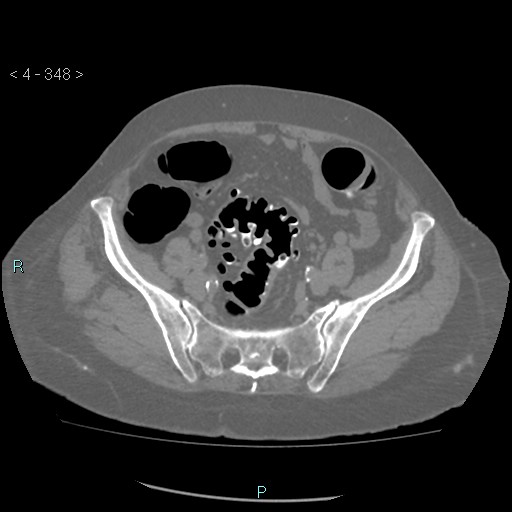 Colonic lipomas (Radiopaedia 49137-54244 Axial bone window 156).jpg