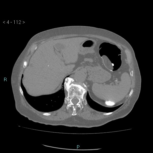 Colonic lipomas (Radiopaedia 49137-54244 Axial bone window 50).jpg
